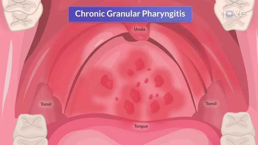 Chronic Pharyngitis