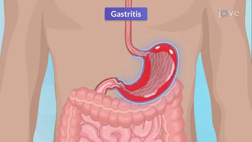 Gastritis-I: Einführung und Arten