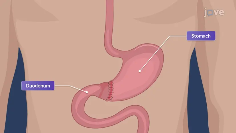 Peptische Ulkuskrankheit V: Chirurgisches Management und Pflege